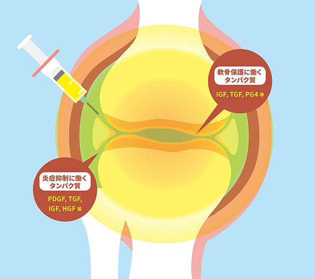 ACP PRP療法のイメージ