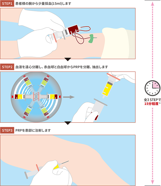 治療のステップ